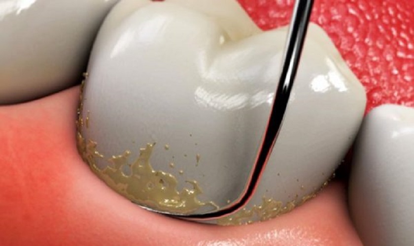 Cạo vôi răng có đau và chảy máu không?