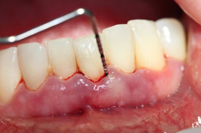 Cạo vôi răng có thể bị chảy máu nếu không thực hiện đúng kỹ thuật