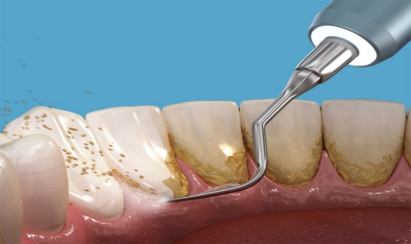 Những người có mảng bám vôi răng có thể thực hiện cạo vôi răng